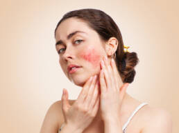 Voeding en rosacea